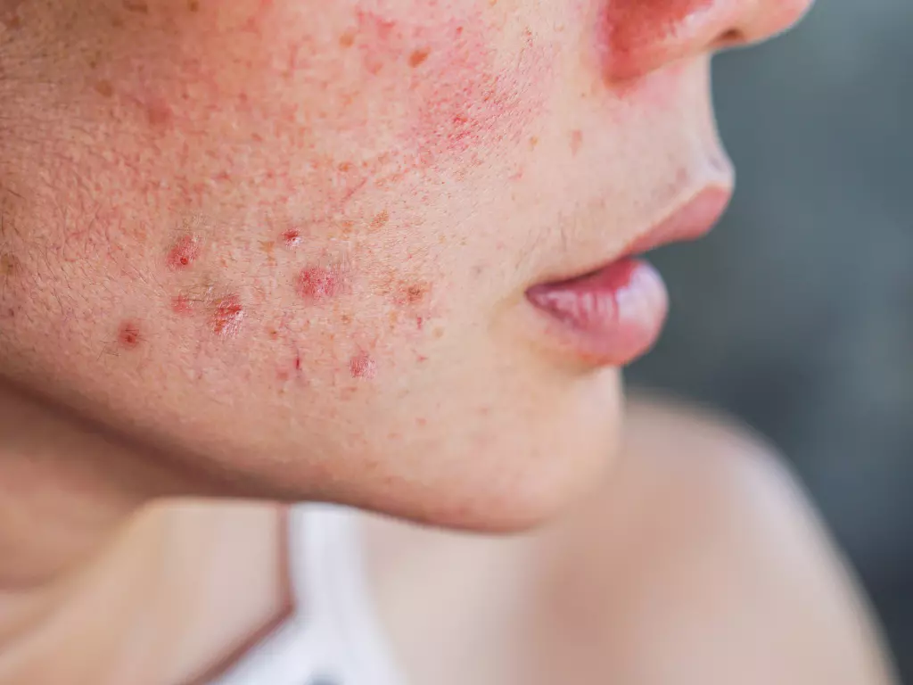 Acne-Prone Skin
